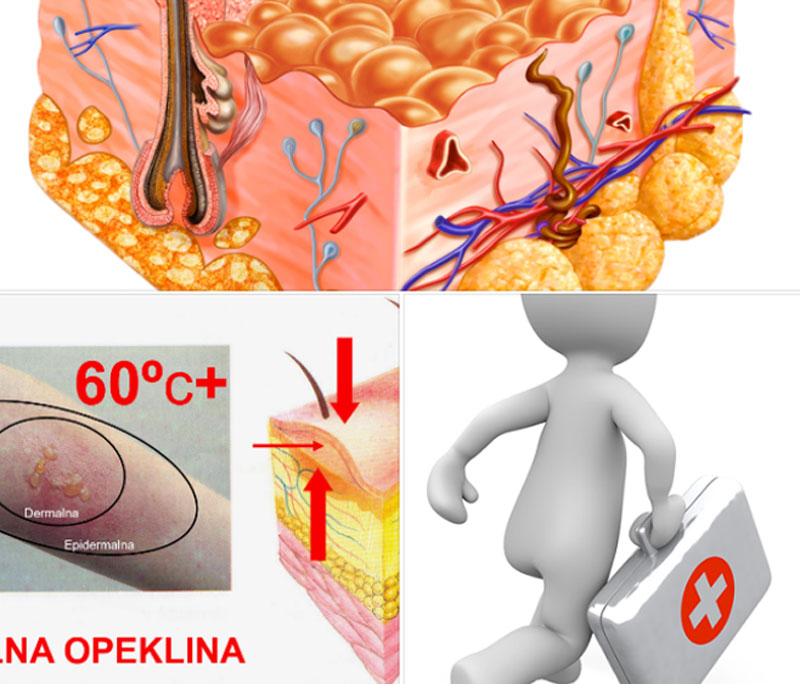 gasilska taktika - opekline